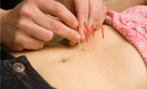 Acupuncture Treatment – Acupuncture for Stress Symptoms