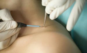 Kiss Warts Goodbye: Tried and Tested Treatment Approaches