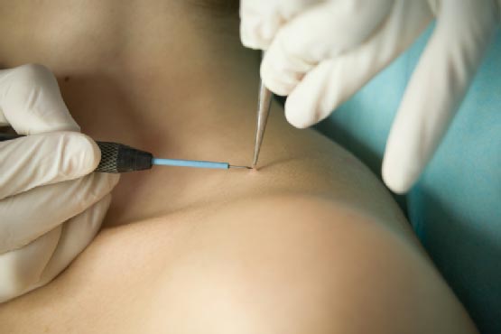 Kiss Warts Goodbye: Tried and Tested Treatment Approaches