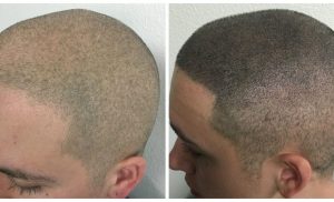 A Palette of Possibilities: The Art of Scalp Micropigmentation for Hair Loss