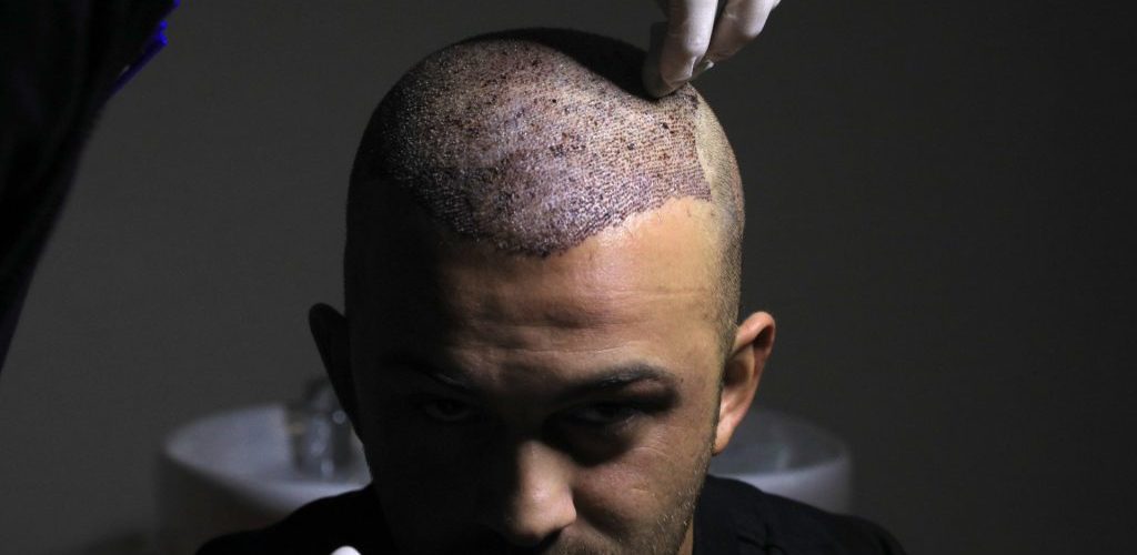 Hair Transplants in Asia: Trends and Innovations