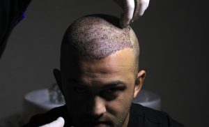 Hair Transplants in Asia: Trends and Innovations